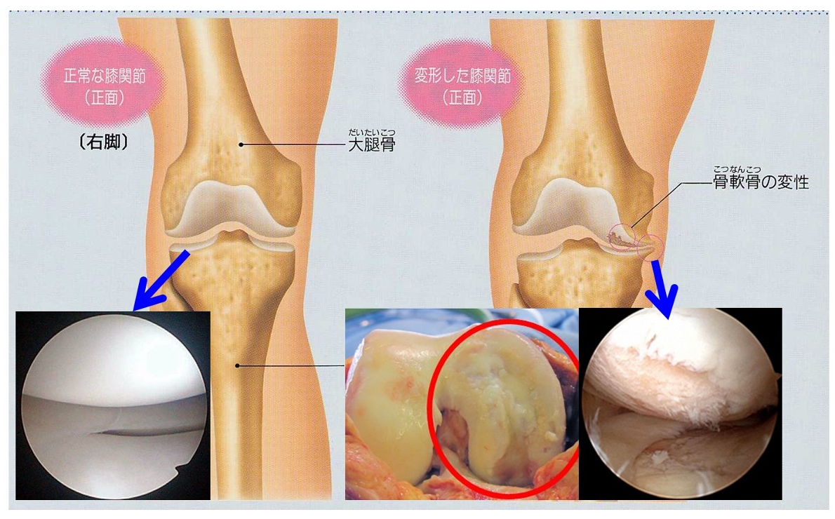 変形性膝関節症 お知らせ 医療法人社団 かとう整形外科 病院 介護ナビ Milmil