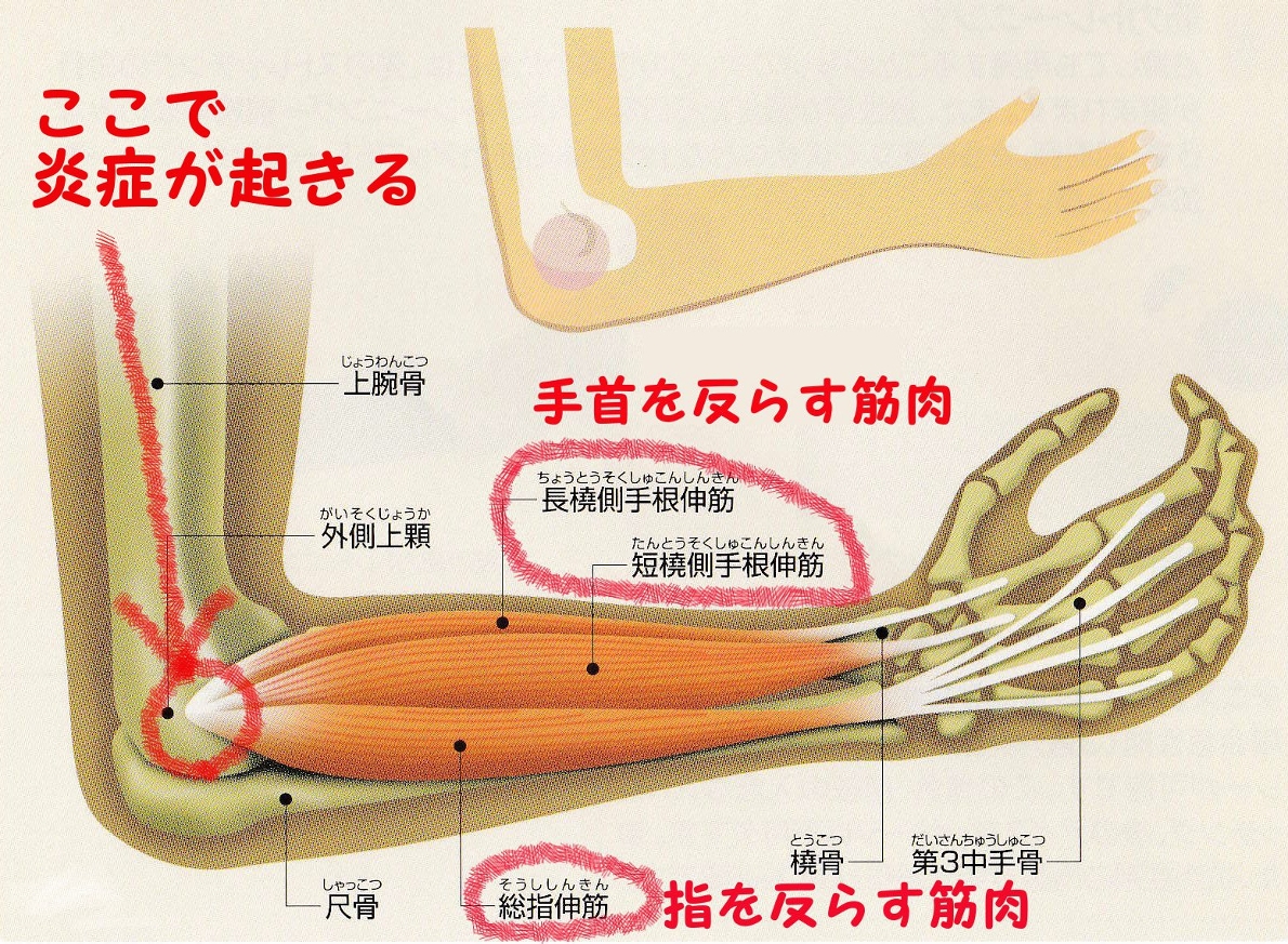アキレス腱断裂（あきれすけんだんれつ） | 福岡の弁護士による後遺障害・等級認定サポート