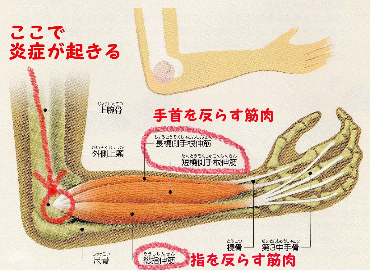 肘 の 腱 が 痛い