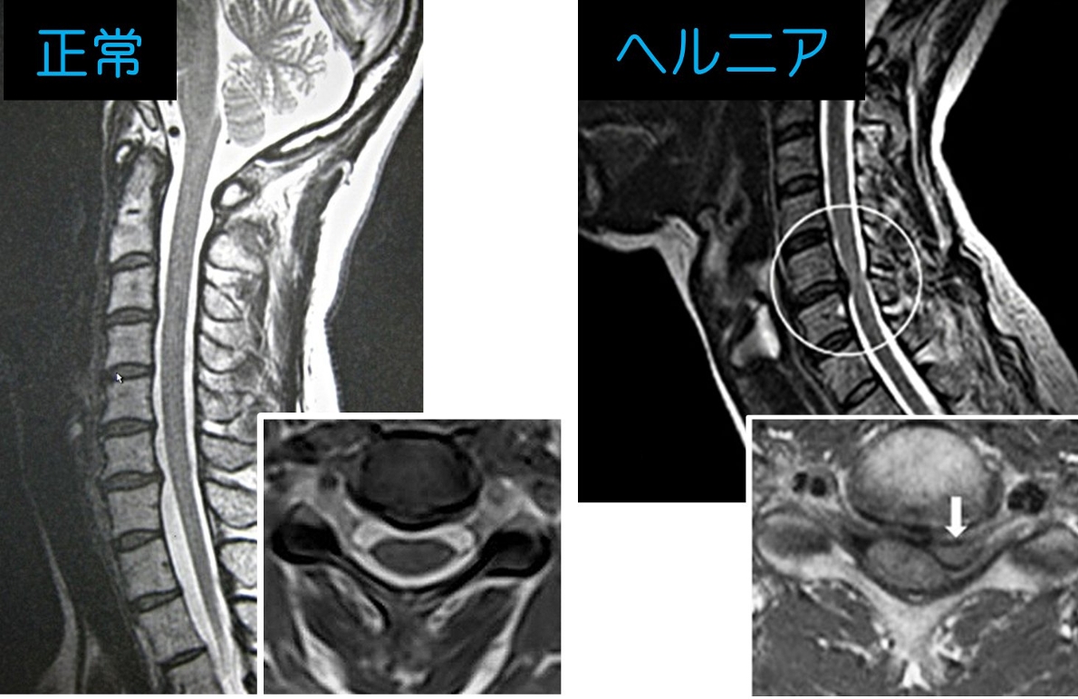 頚椎 ヘルニア 寝れ ない