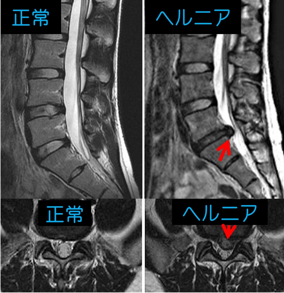 腰痛 反 る と 痛い ヘルニア