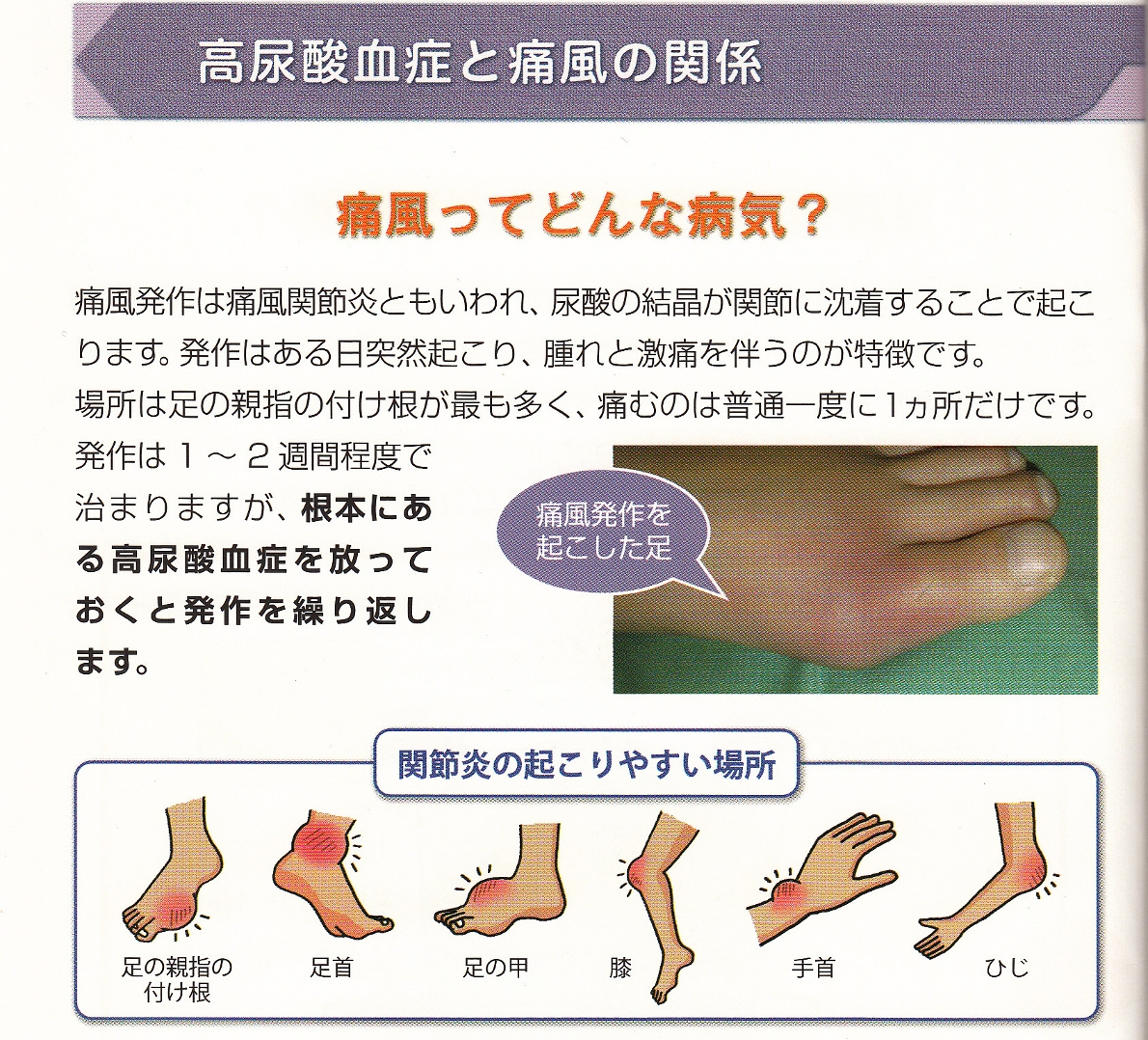 痛風 お知らせ 医療法人社団 かとう整形外科 病院 介護ナビ Milmil
