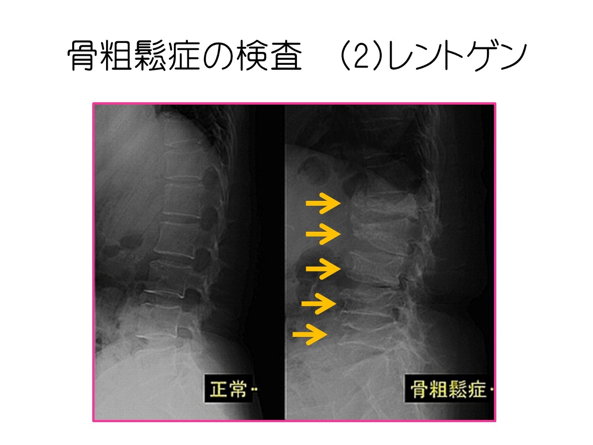 骨粗しょう症の検査 お知らせ 医療法人社団 かとう整形外科 病院 介護ナビ Milmil