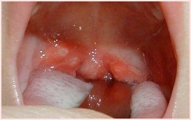 ヘルパンギーナ口内炎5