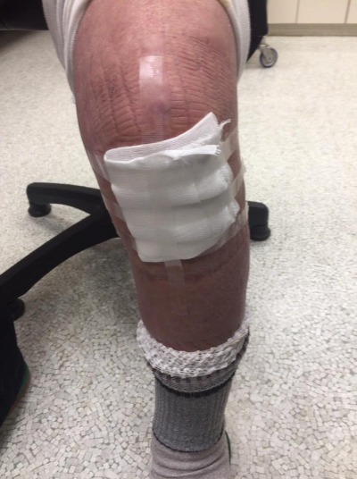 足のケガ、怪我、けが、切り傷、消毒