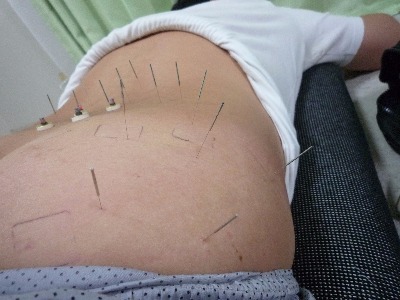 鍼灸、針治療,初動負荷運動トレーニングマ