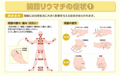 関節リウマチ、朝のこわばり、筋肉のこわば