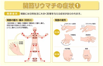 朝 の こわばり リウマチ 以外