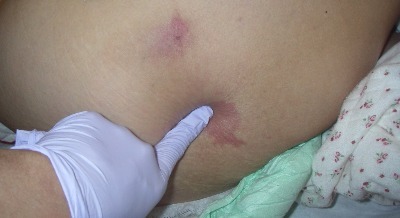 香川県善通寺市トレーニング、ジム、褥瘡、