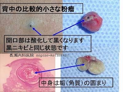 粉瘤、ニキビ、できもの治療、皮膚科、善通