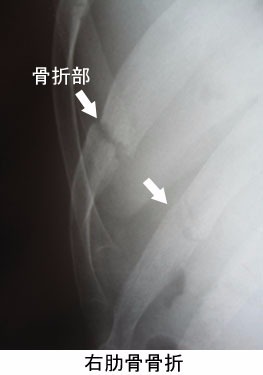 肋骨骨折、肋軟骨骨折、肋骨固定術、バスト