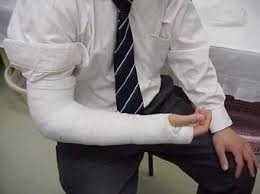 丸亀、善通寺、ギブス、ギプス固定、骨折早