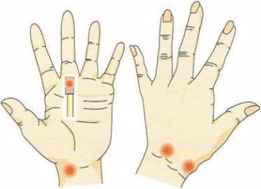 善通寺、ガングリオン、手のしこり、症状、