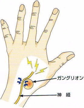 善通寺、ガングリオン症状、治療、ふじた医
