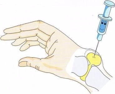 善通寺、ガングリオン、診断、注射、超音波
