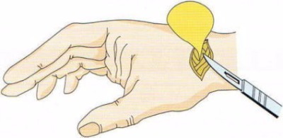 丸亀、善通寺、ガングリオン症状、治療、ふ