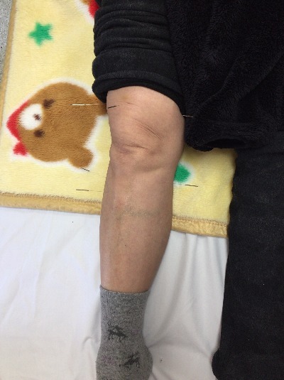 藤本、鍼灸、初動負荷運動トレーニングマシ