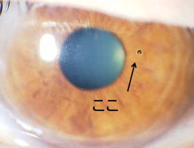 善通寺 丸亀   目に鉄粉 異物 ゴミ 