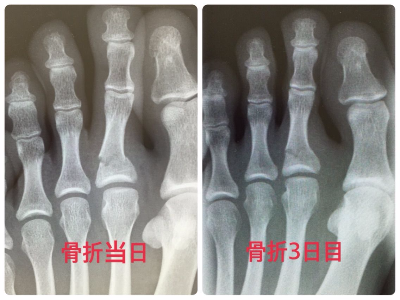 善通寺 丸亀 足の骨折 捻挫 ひび ふじ