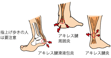 アキレス腱が痛い時の原因と治療方法 お知らせ 交通事故治療 整形外科病院 ふじた医院 病院 介護ナビ Milmil