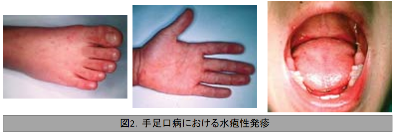 善通寺 丸亀  夏 流行 手足口病 ヘル