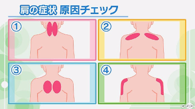 善通寺 丸亀 肩こり・肩の痛み対策「肩こ