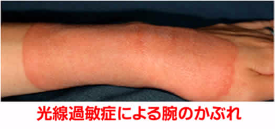善通寺 丸亀   皮膚科 光線過敏症 モ
