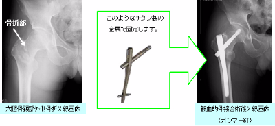 丸亀 善通寺  足の骨折 大腿骨骨折 ふ