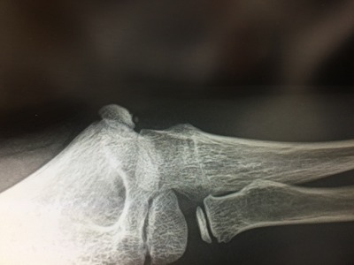 善通寺 丸亀 野球肘 スポーツ整形 リハ