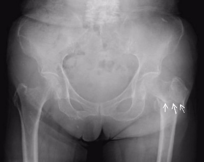 丸亀 善通寺 大腿骨骨折 手術 治療 合