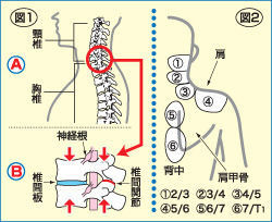 善通寺 丸亀 頚椎症性脊髄症 頚椎椎間板