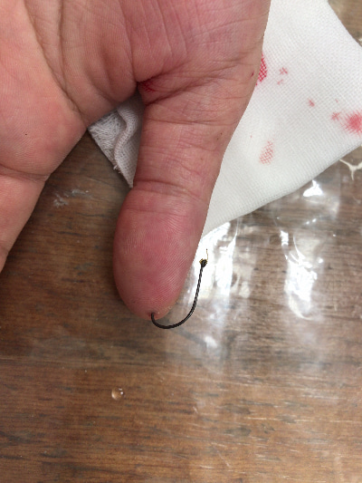 善通寺 丸亀 釣り針 手に刺さった 抜く