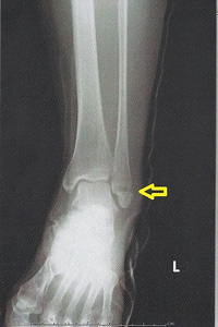 丸亀 善通寺  足首捻挫 骨折 ふじた医