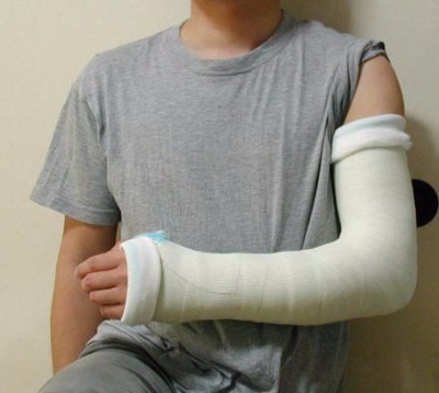 骨折、ギプス固定