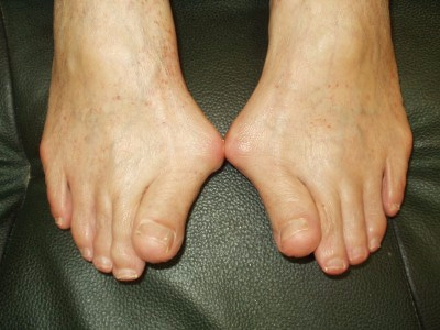 善通寺 丸亀 外反母趾 靴選び ふじた医