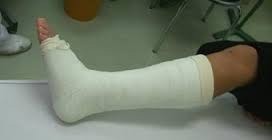 善通寺、丸亀、骨折、ギプス、ギブス固定、
