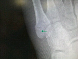 善通寺、丸亀、亀裂骨折、ギプス、ギブス固