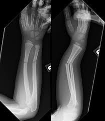 手首骨折、初動負荷運動トレーニングマシー