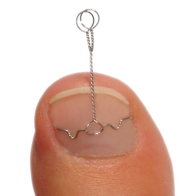 善通寺、丸亀、巻き爪、治療、ふじた医院